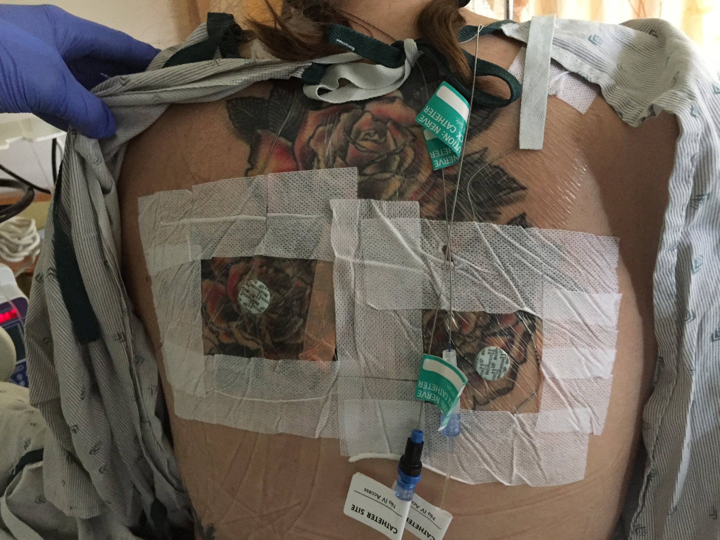 Back ON-Q catheters 