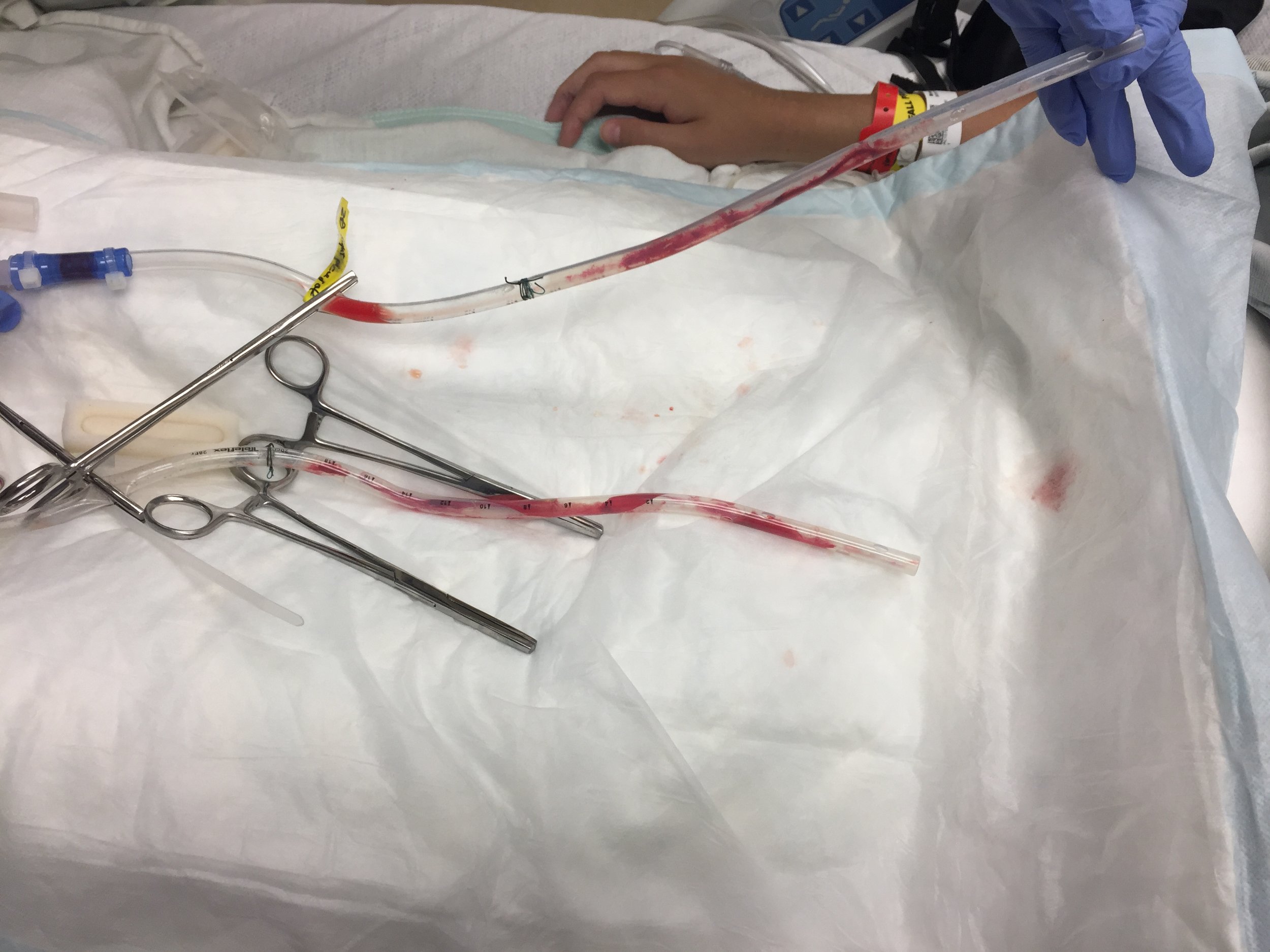 That was in her upper left lung area! 