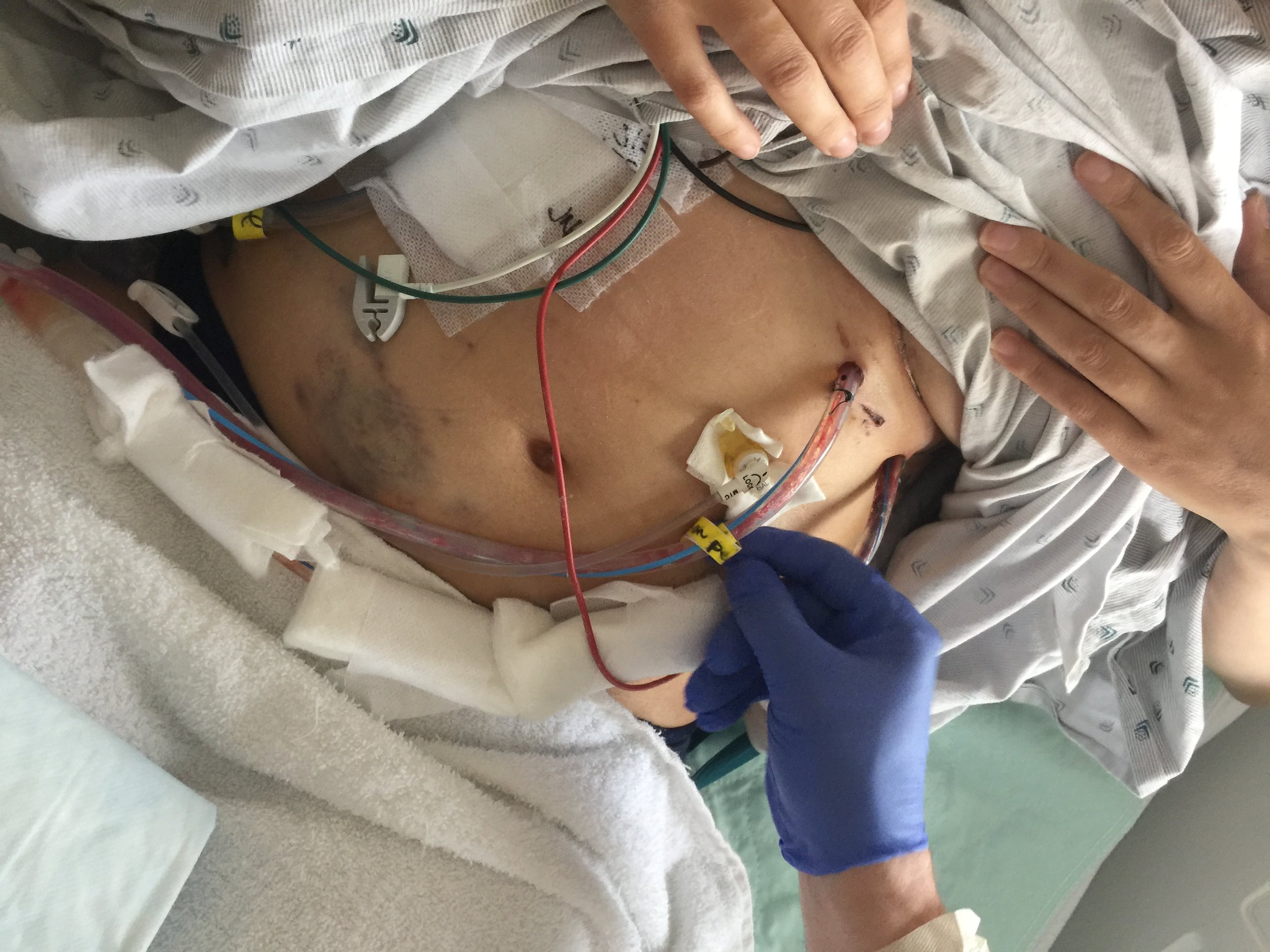 checking the chest tubes 