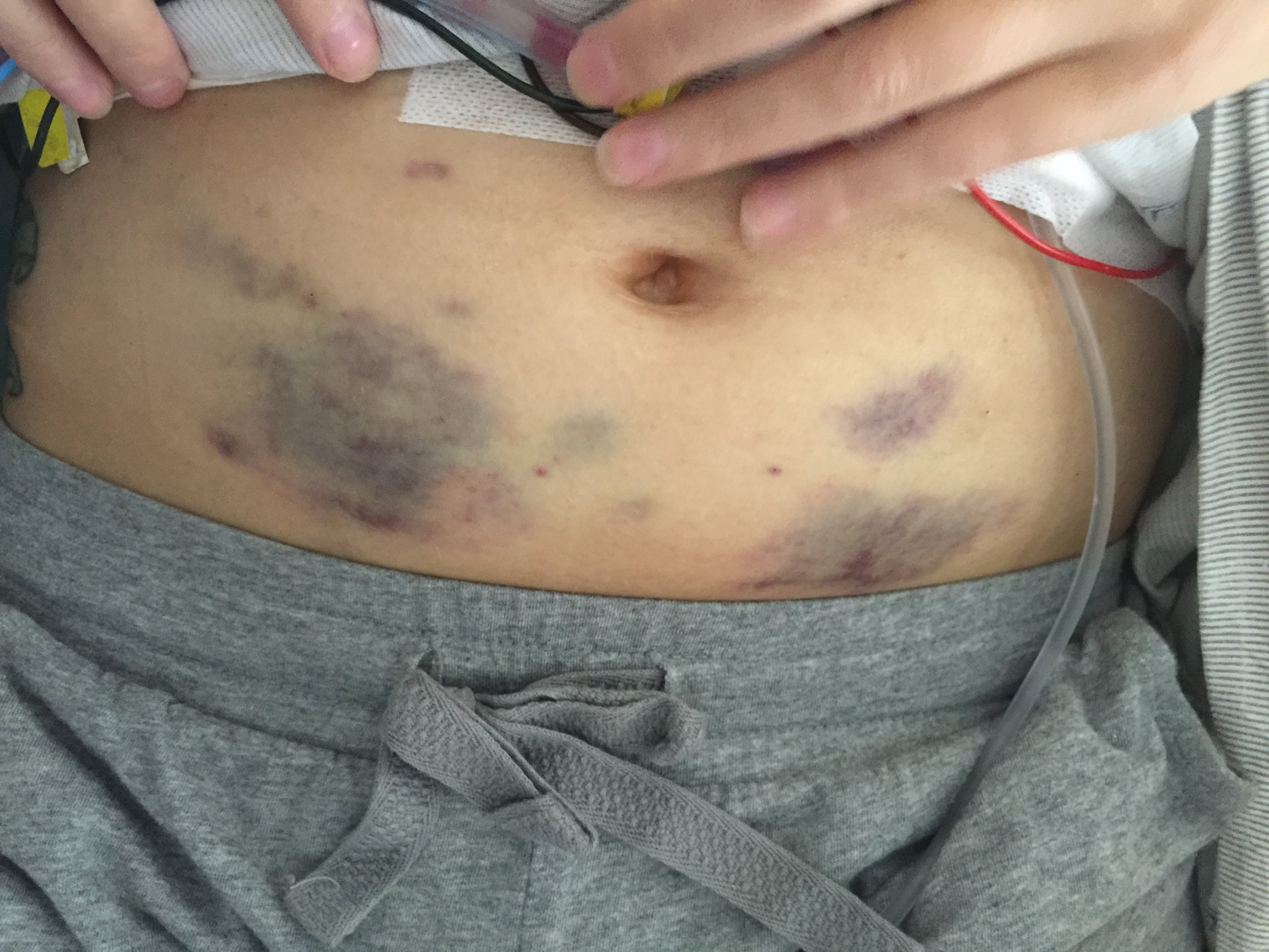 bruises from the heparin
