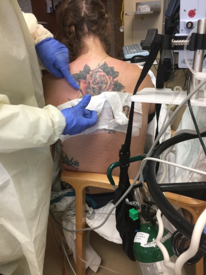 Getting the back catheters out 