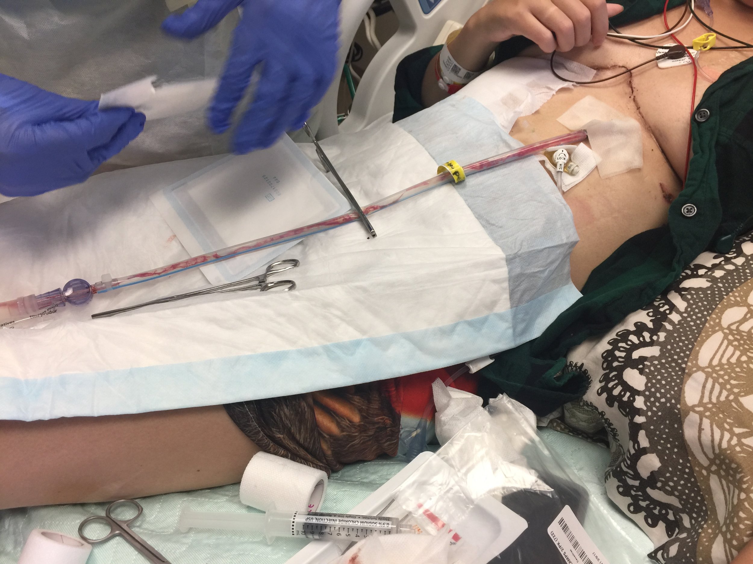 last chest tube about to be pulled 