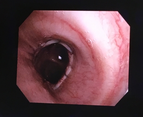 The area where old airway meets new lung. Those sutures will be there forever.