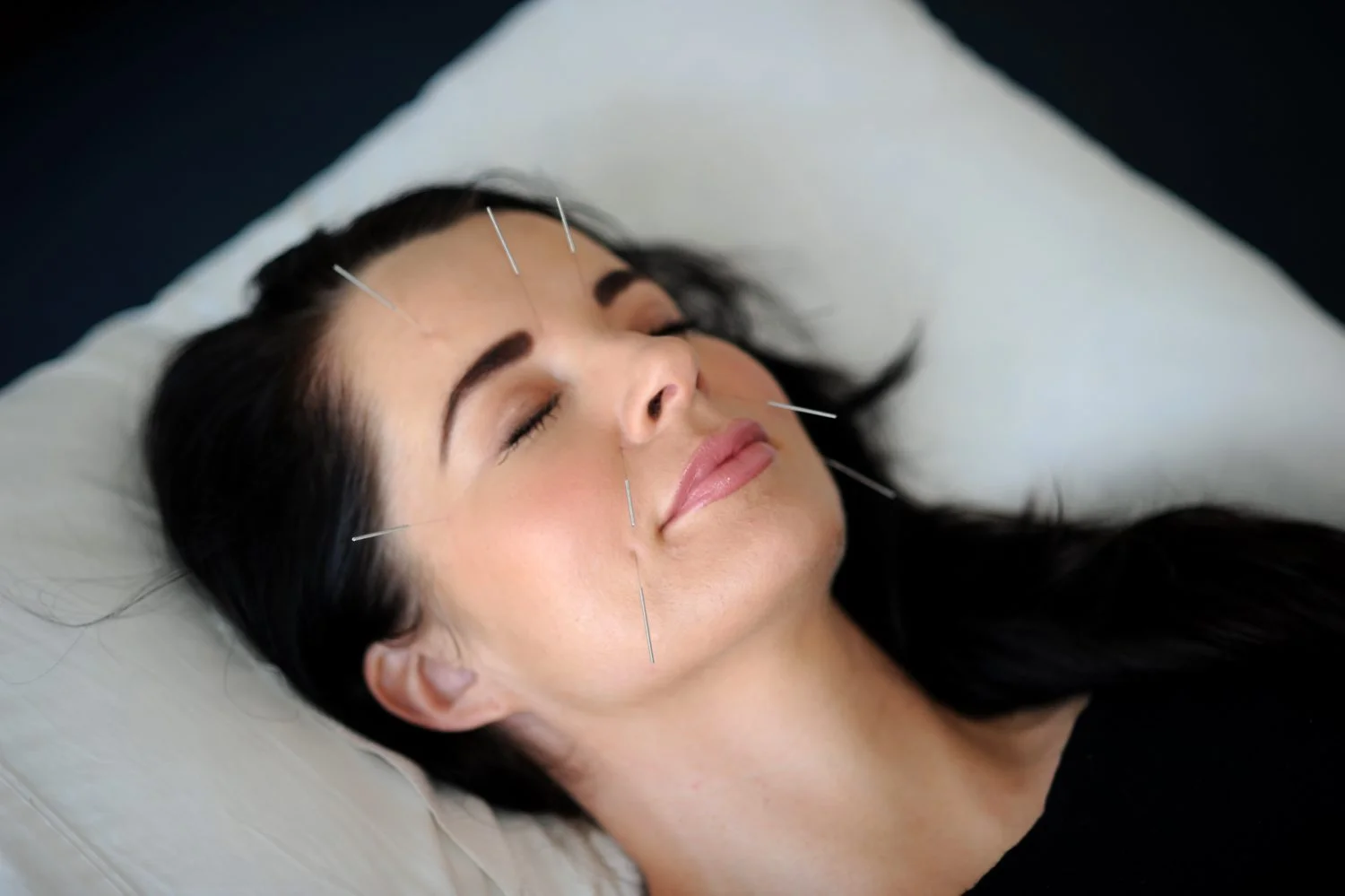 Facial-accupuncture1.jpg