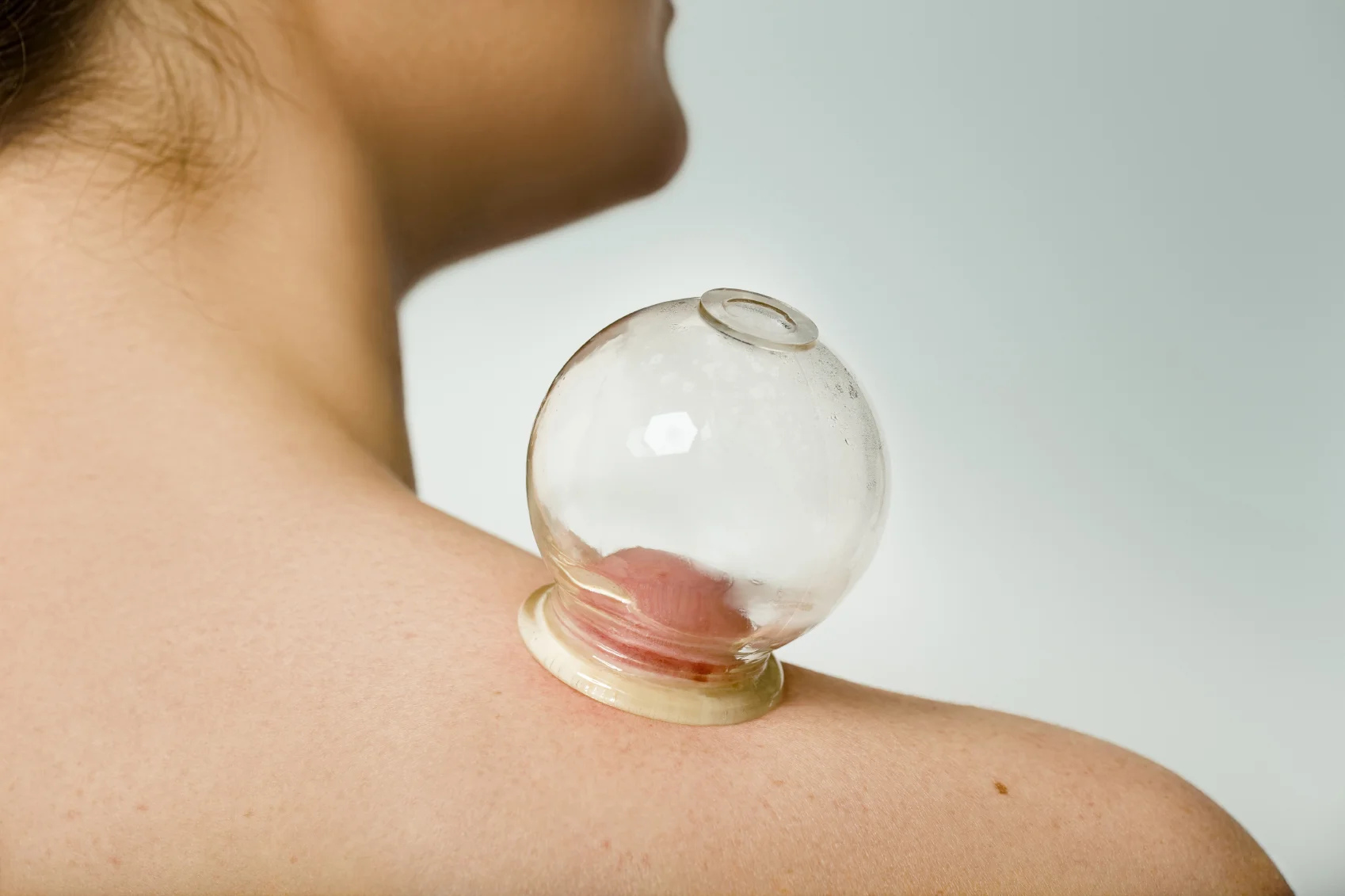 Cupping.jpg