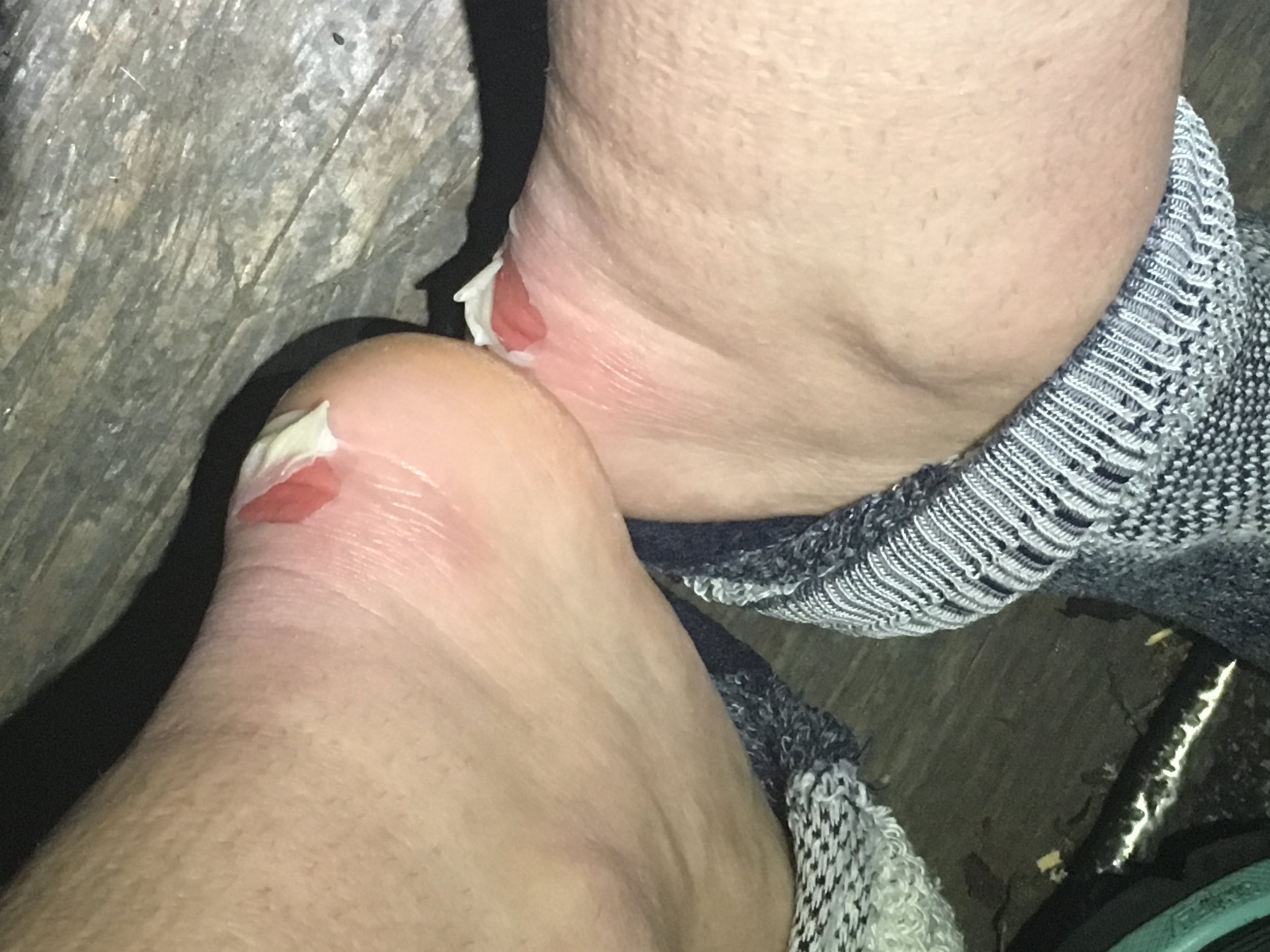 Hiking with blisters sucks