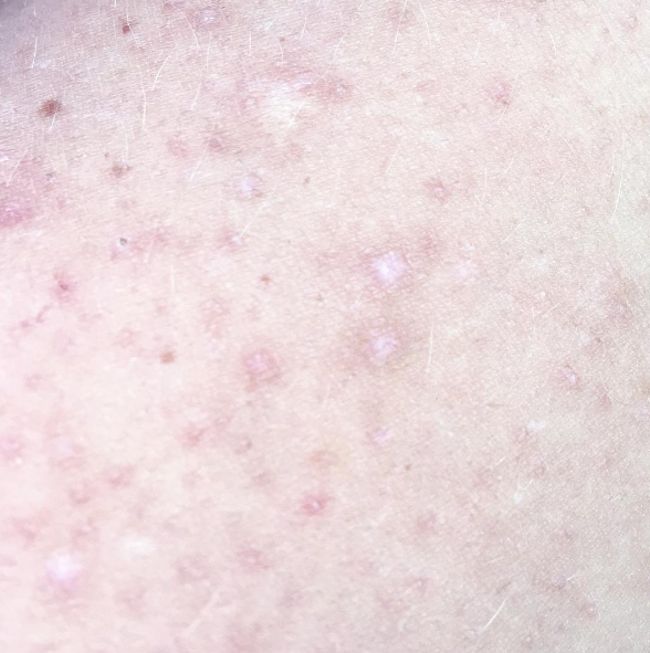 Scars and Stretch Marks
