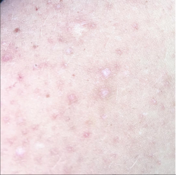 Scars and Stretch Marks