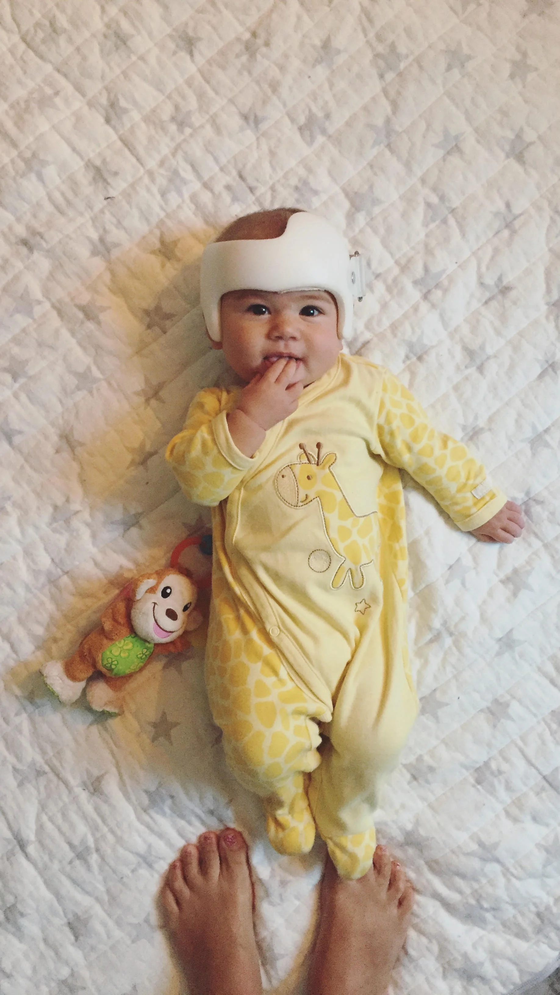 Baby Helmet Therapy for Plagiocephaly