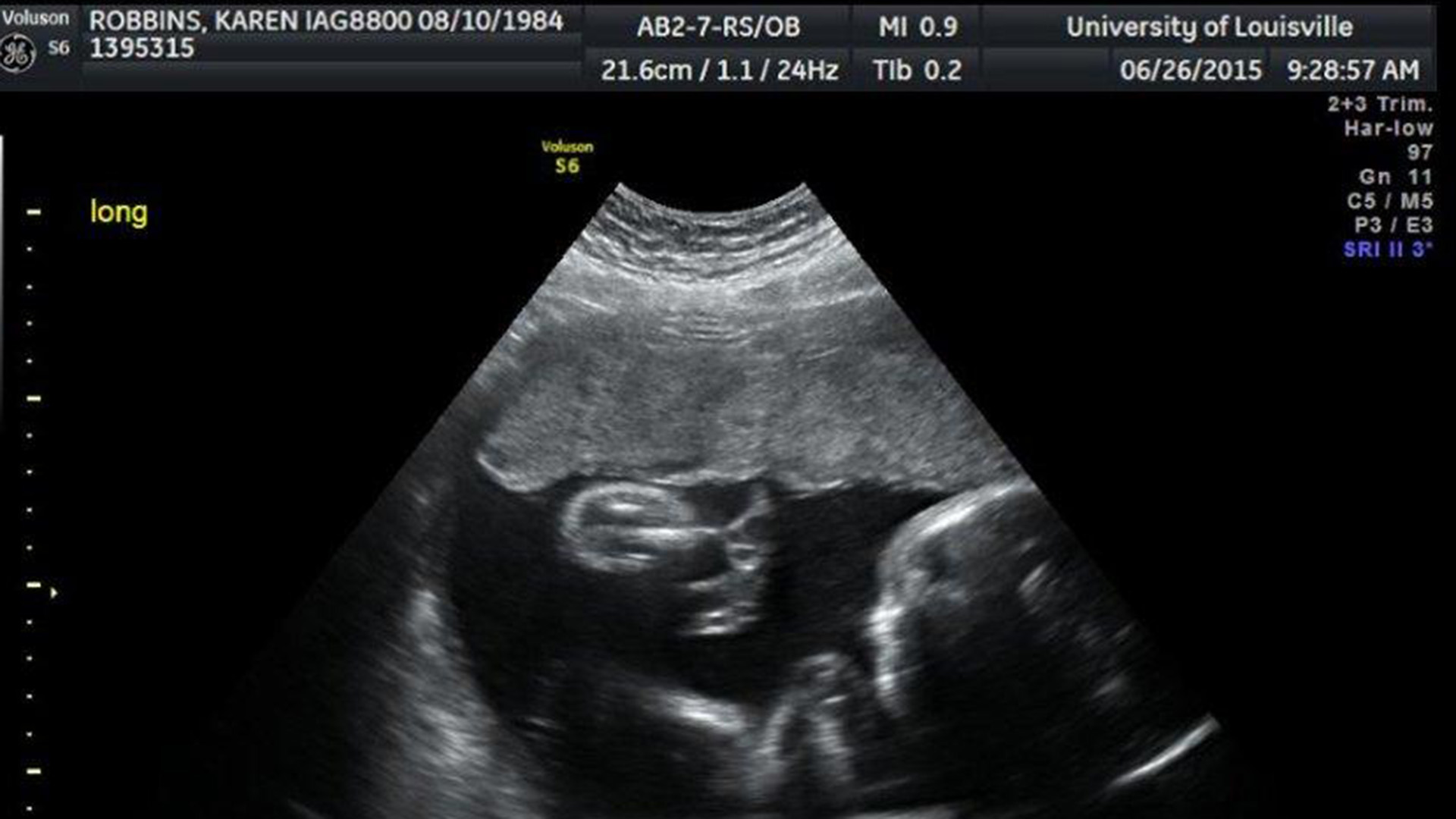 Ultrasound of Karen's unborn baby. 