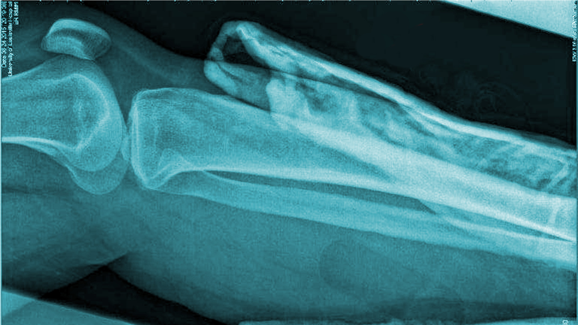 X-ray leg.jpg