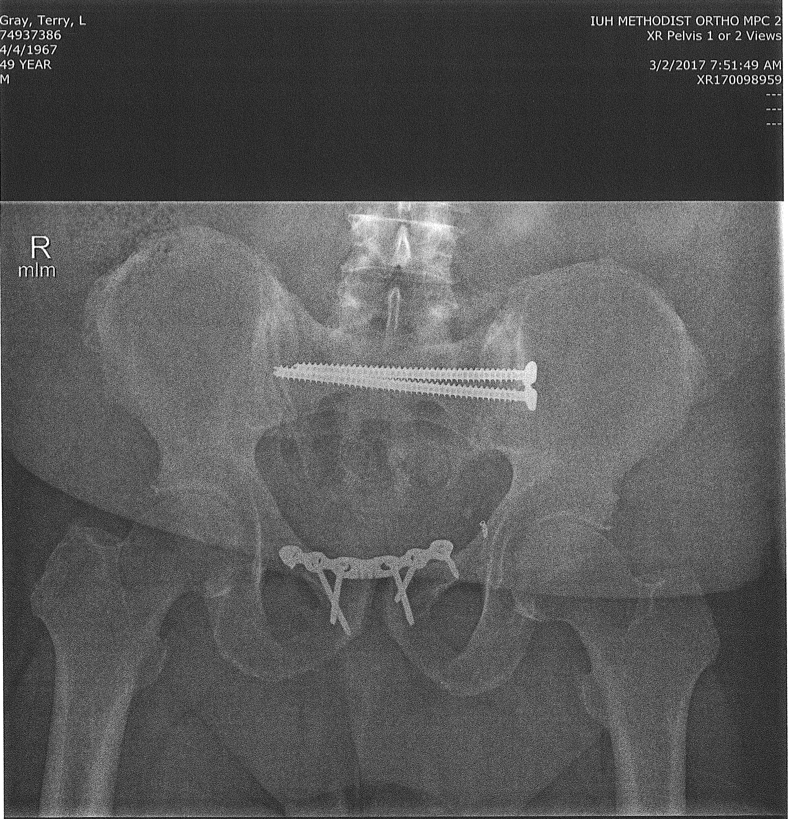 X-rays showing Mr. Gray's pelvic hardware. 