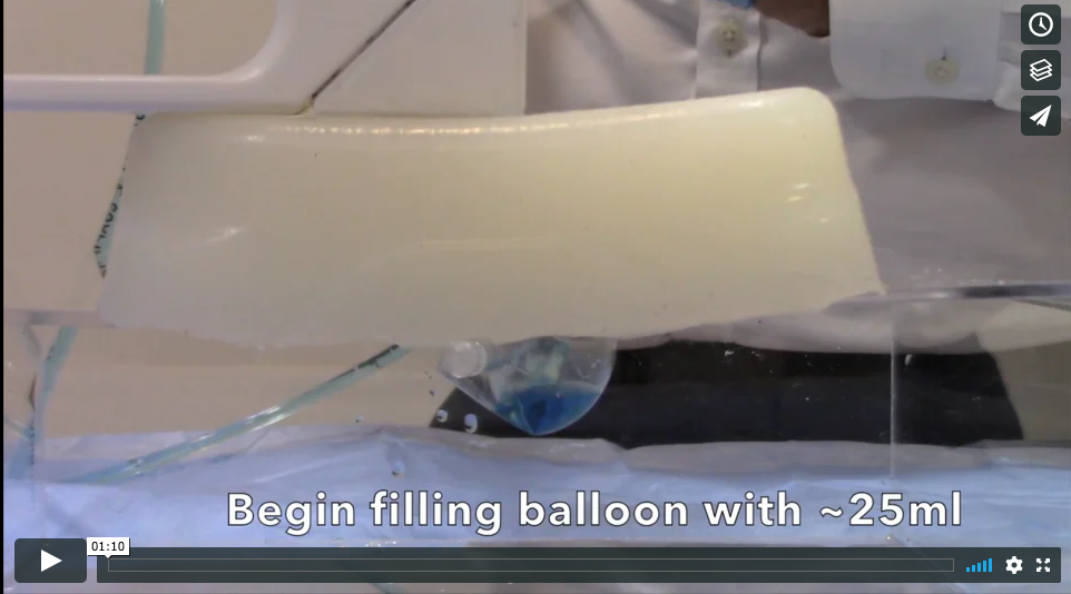 Short video demonstrates how to remove air from existing balloon catheter, ensuring the best ultrasound visualization during PUG (percutaneous ultrasound gastrostomy). 