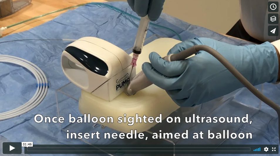 Short video of proper and improper technique for inserting guidewire, once the balloon is punctured. 