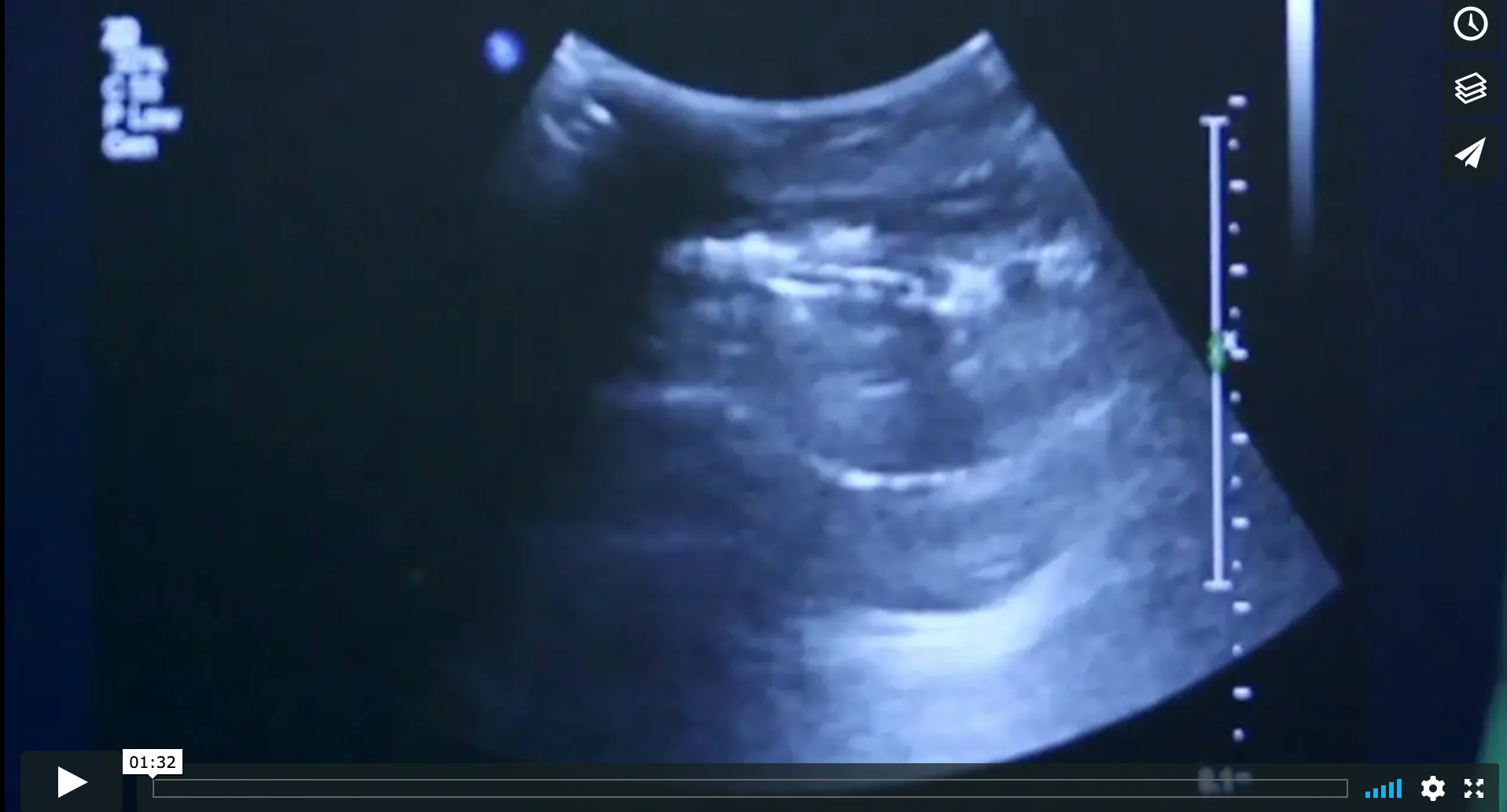  PUG Procedure live POCUS video