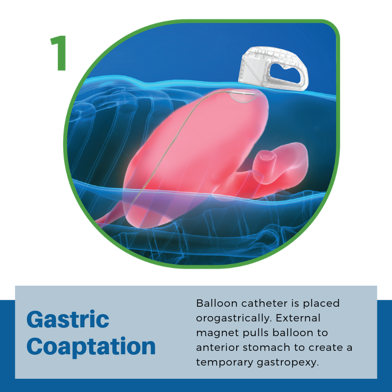 PUG Step 1: Gastric Coaptation