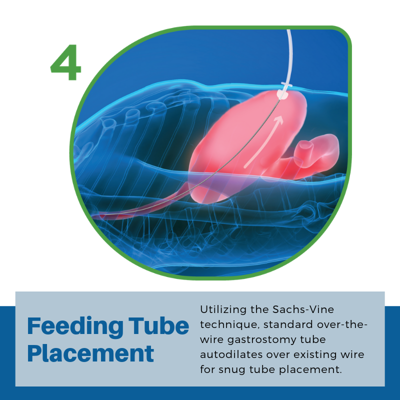PUG Step 4: Feeding Tube Placement