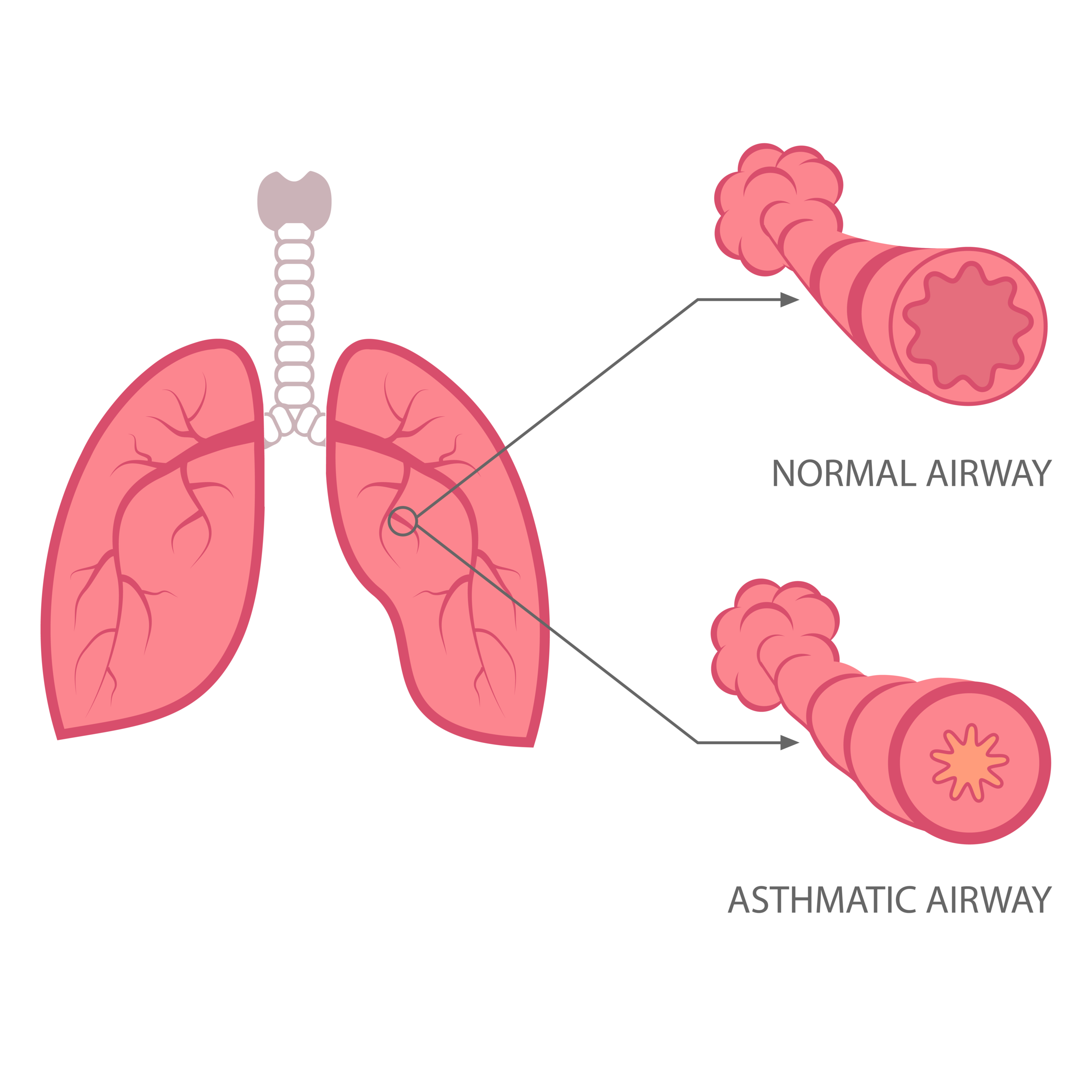 Mitex Allergy AntiAllergy Beds — Acute Bronchitis