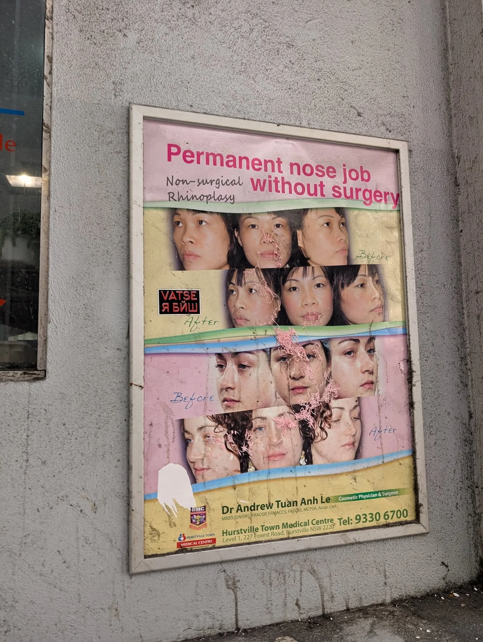 Do I want a permanent nose job without surgery?