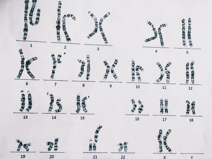 Alicia's chromosmal analysis