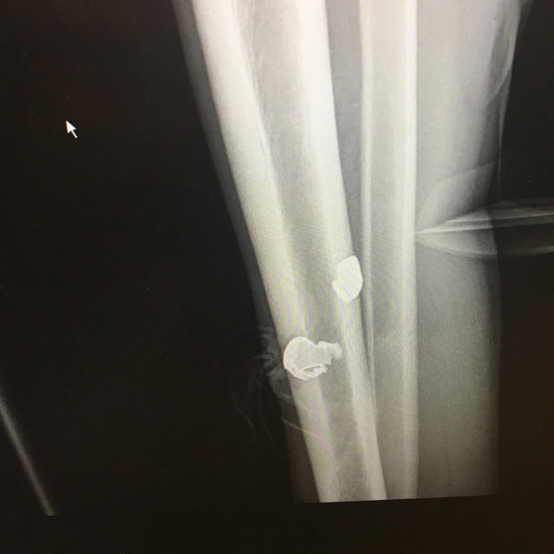 Gun Shot Wound X-ray from a patient we took care of in the emergency department