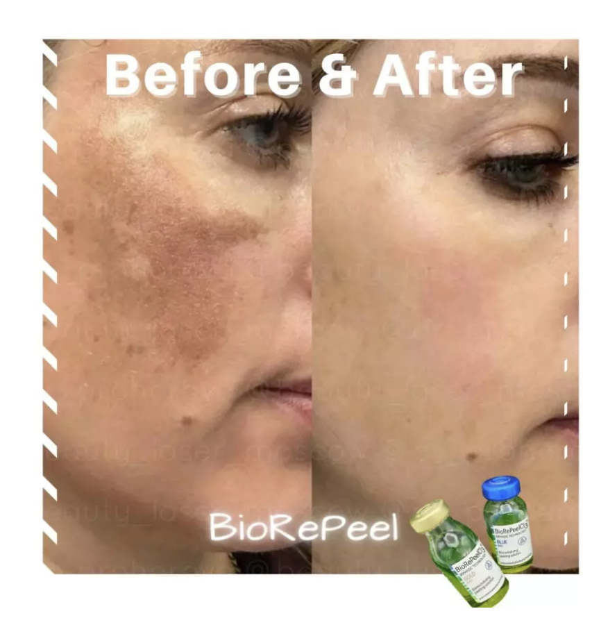 Melasma