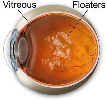 floaters.jpg