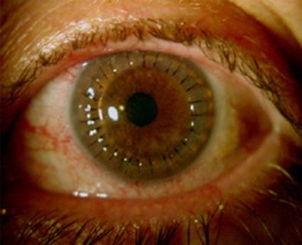 Cornea with stitches, post transplant