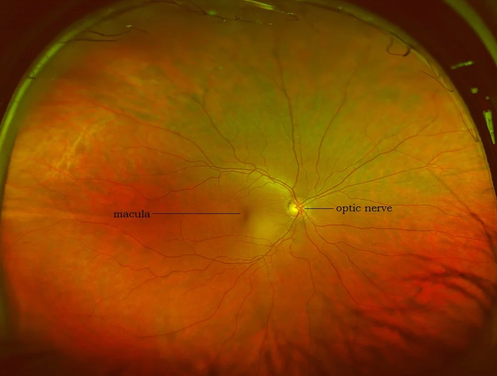Optomap retinal scan image of a healthy retina