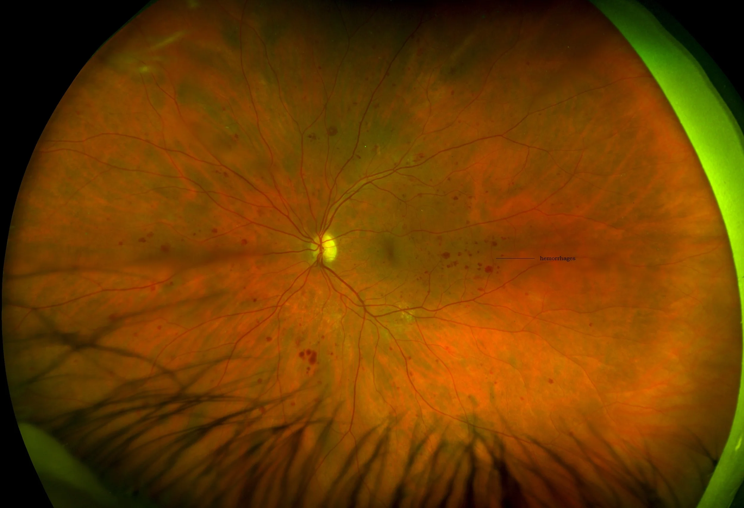 Optomap retinal scan of a retina with diabetic retinopathy