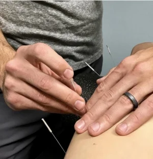 dry needling chiropractor