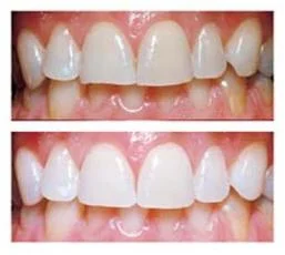 What you need to know about whitening your teeth
