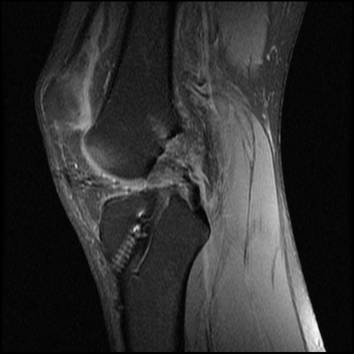 MRI Knee WO - LEFT 0080.jpg