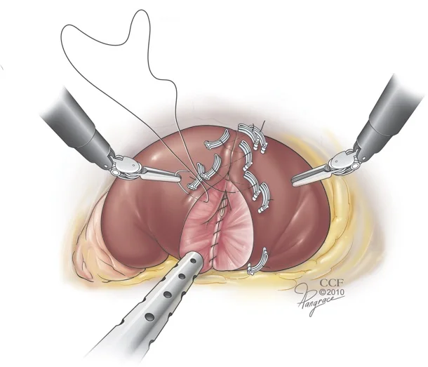 What is laparoscopic robotic partial nephrectomy and when should it be considered?