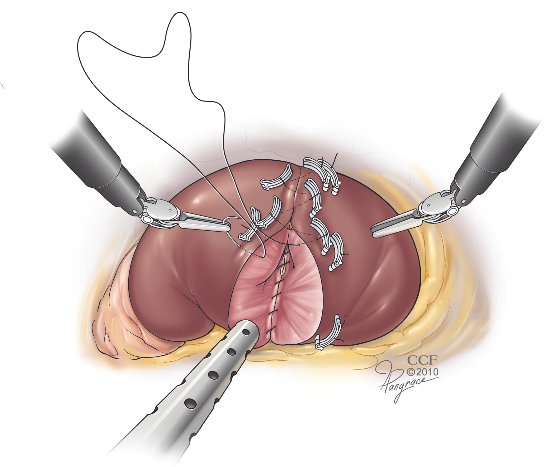 Laparoscopic Partial Nephrectomy