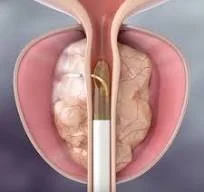 Navigating Minimally Invasive Surgical Therapies (MIST) for BPH: Tailoring Solutions for Individual Needs