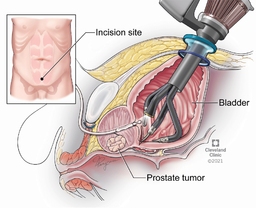 The Future of Urology Surgery: The Robotic Single-Port (SP) Platform