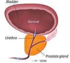 Bladder Cancer Specialist in Melbourne | Bladder Cancer Surgery ...