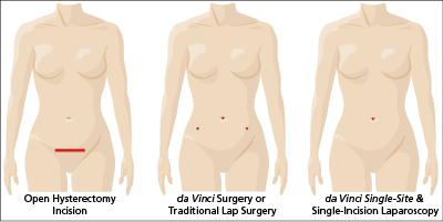 know your Hysterectomy Options: the most common ways to remove your uterus are: open surgery and minimally invasive surgery (traditional laparoscopy or robotically-assisted da Vinci Surgery).