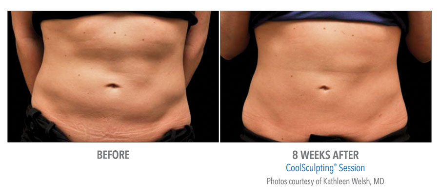 CoolSculpting session before and after stomach image