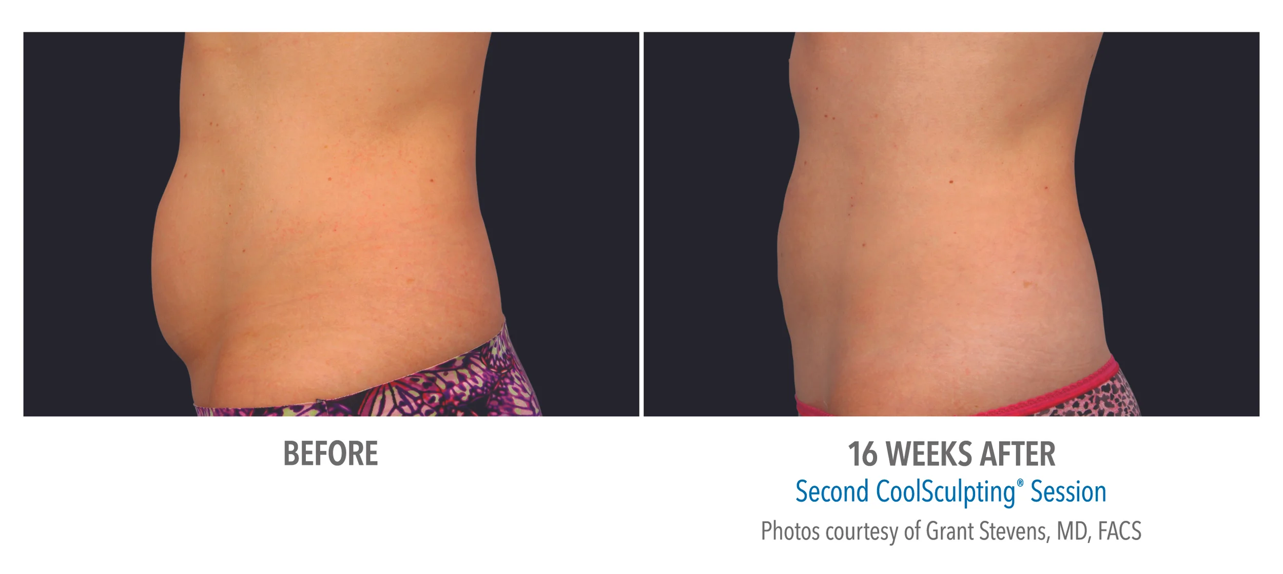 Second CoolSculpting session 16 weeks later stomach side view