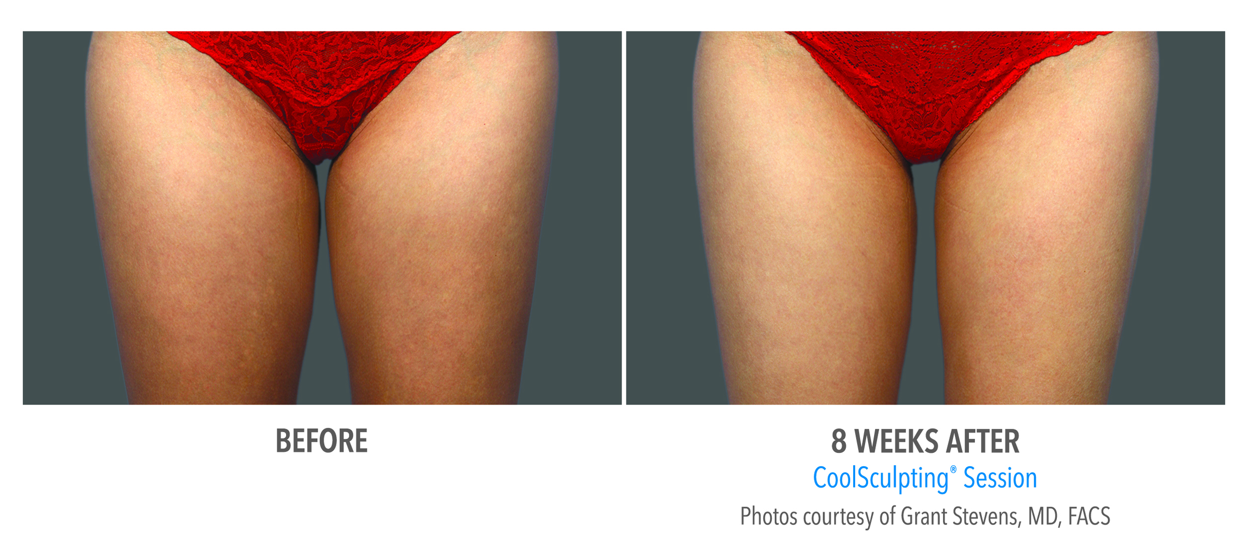 CoolSculpting inner thighs session before and 8 weeks after