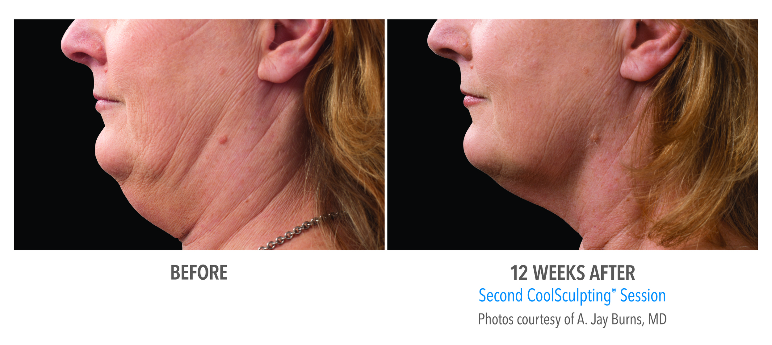 Second CoolSculpting chin session 12 weeks after
