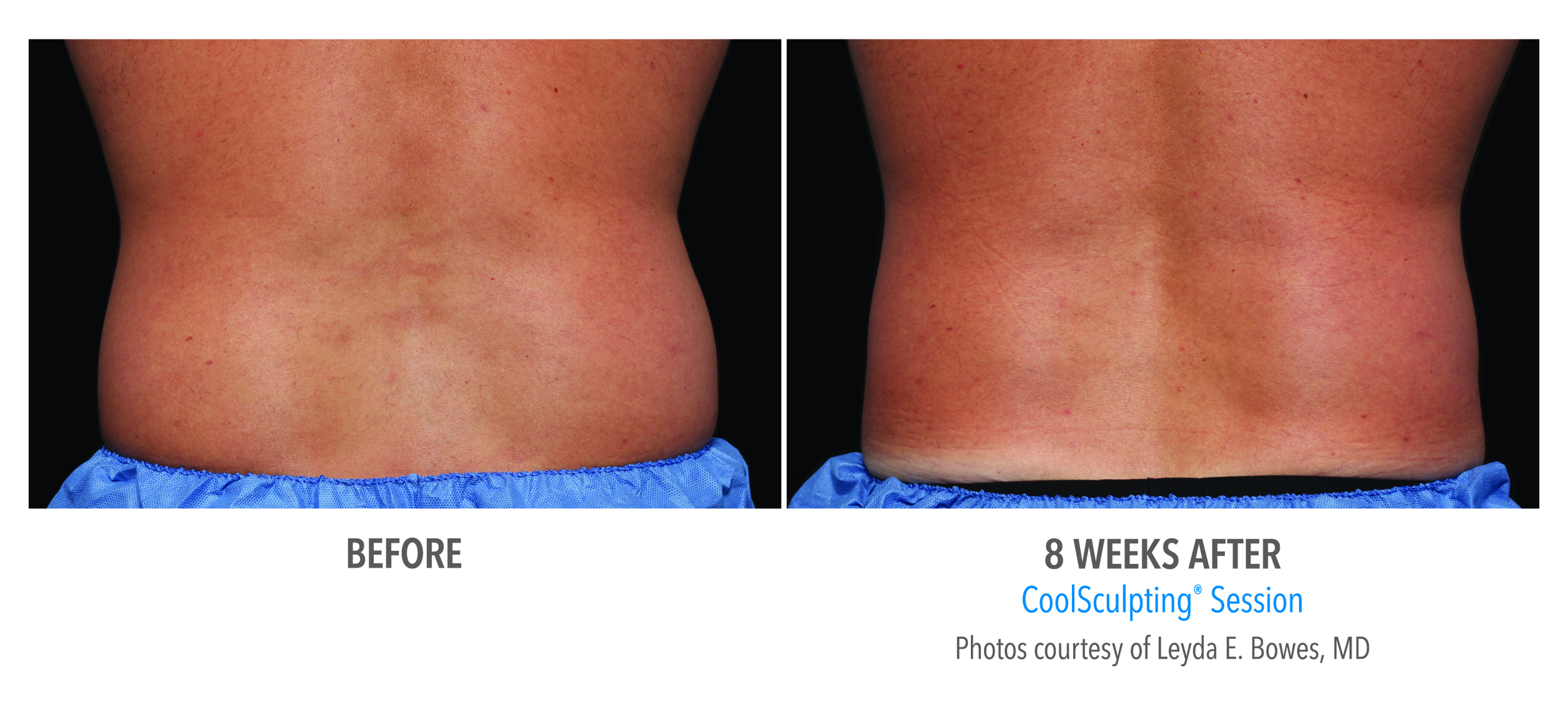 CoolSculpting before and after results for men 8 week session