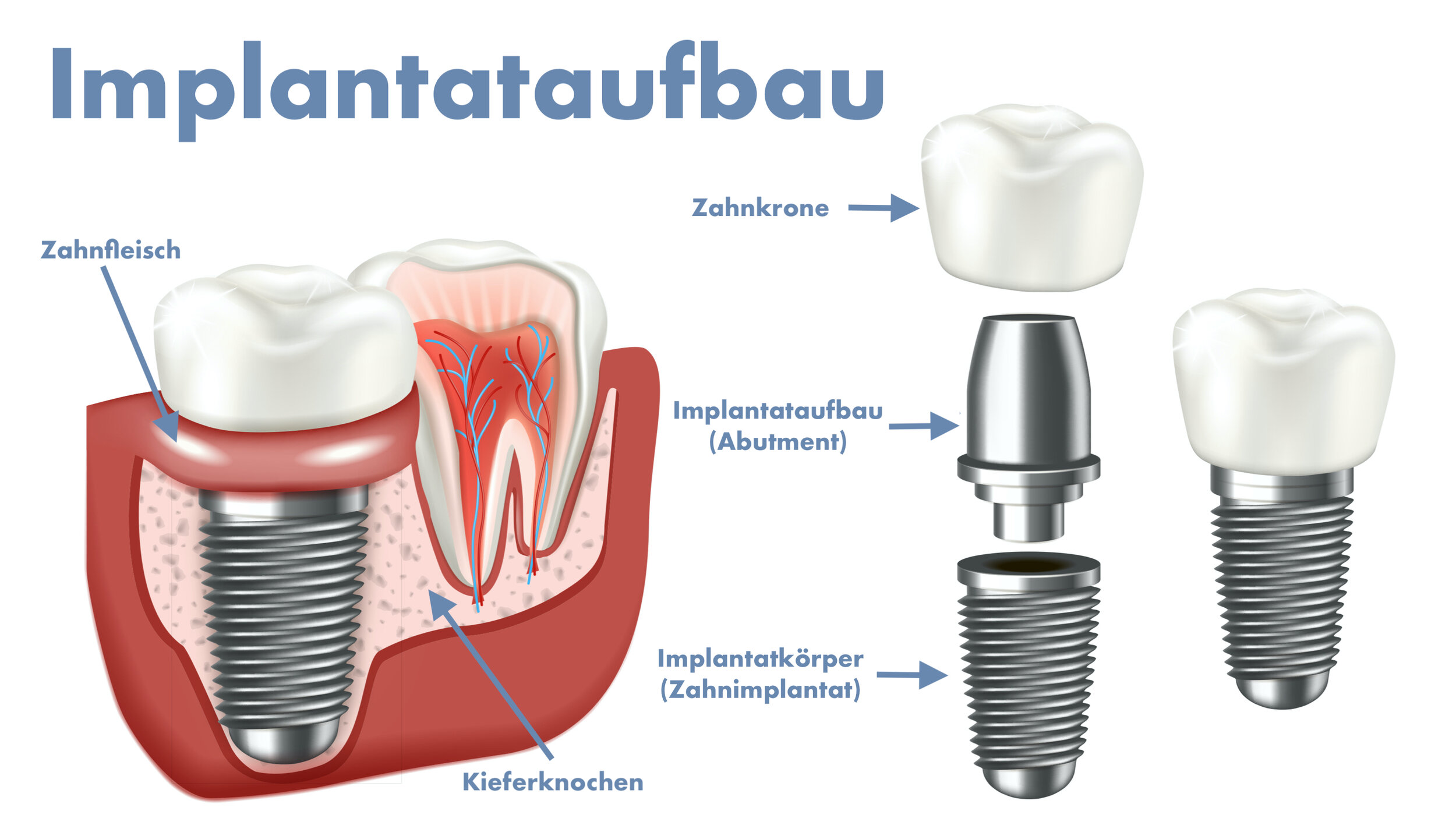 Zahnimplantate Abcdent Zahnzentrum