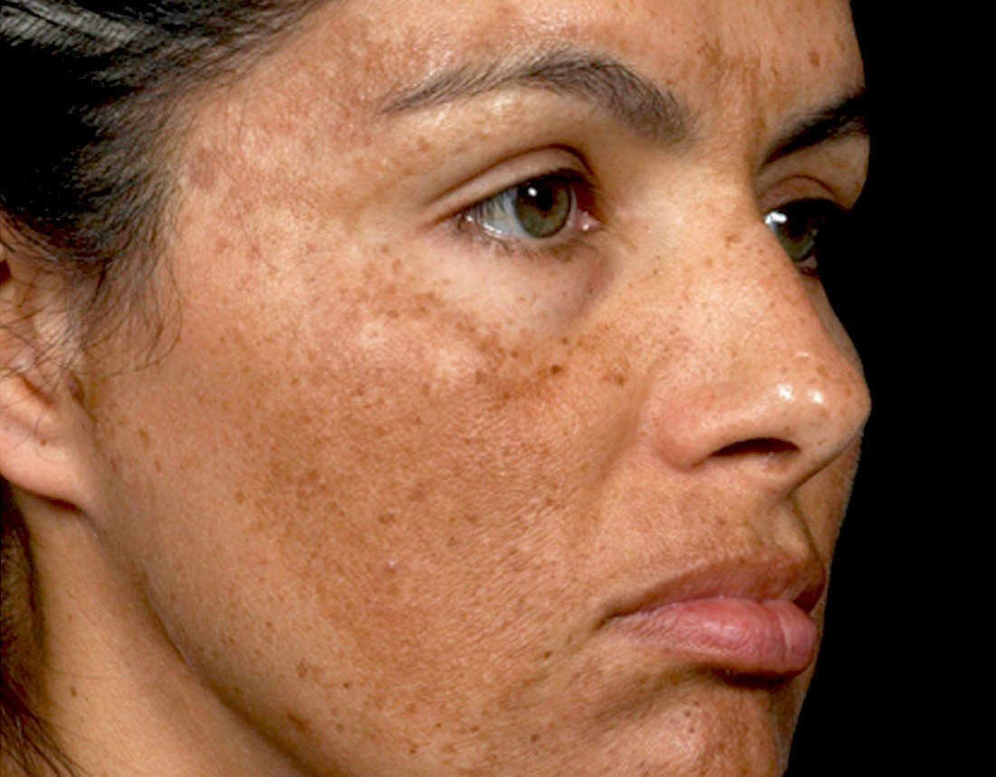 Woman with hyperpigmentation on the face, uv sun damage, acne scarring, PIH, melasma