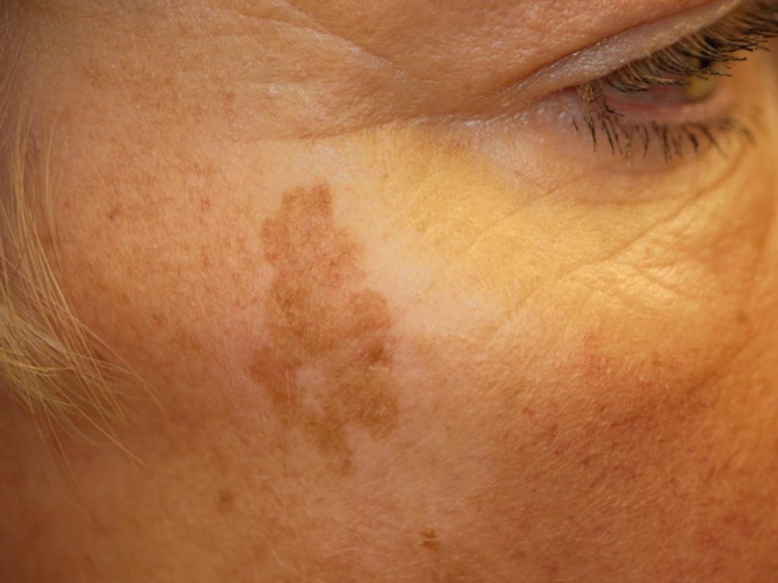 Woman with hyperpigmentation on the face, uv sun damage, acne scarring, PIH, melasma