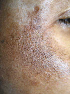 Permanent hyper-pigmentation from ochronosis from hydroquinone skin lightening bleaching treatment