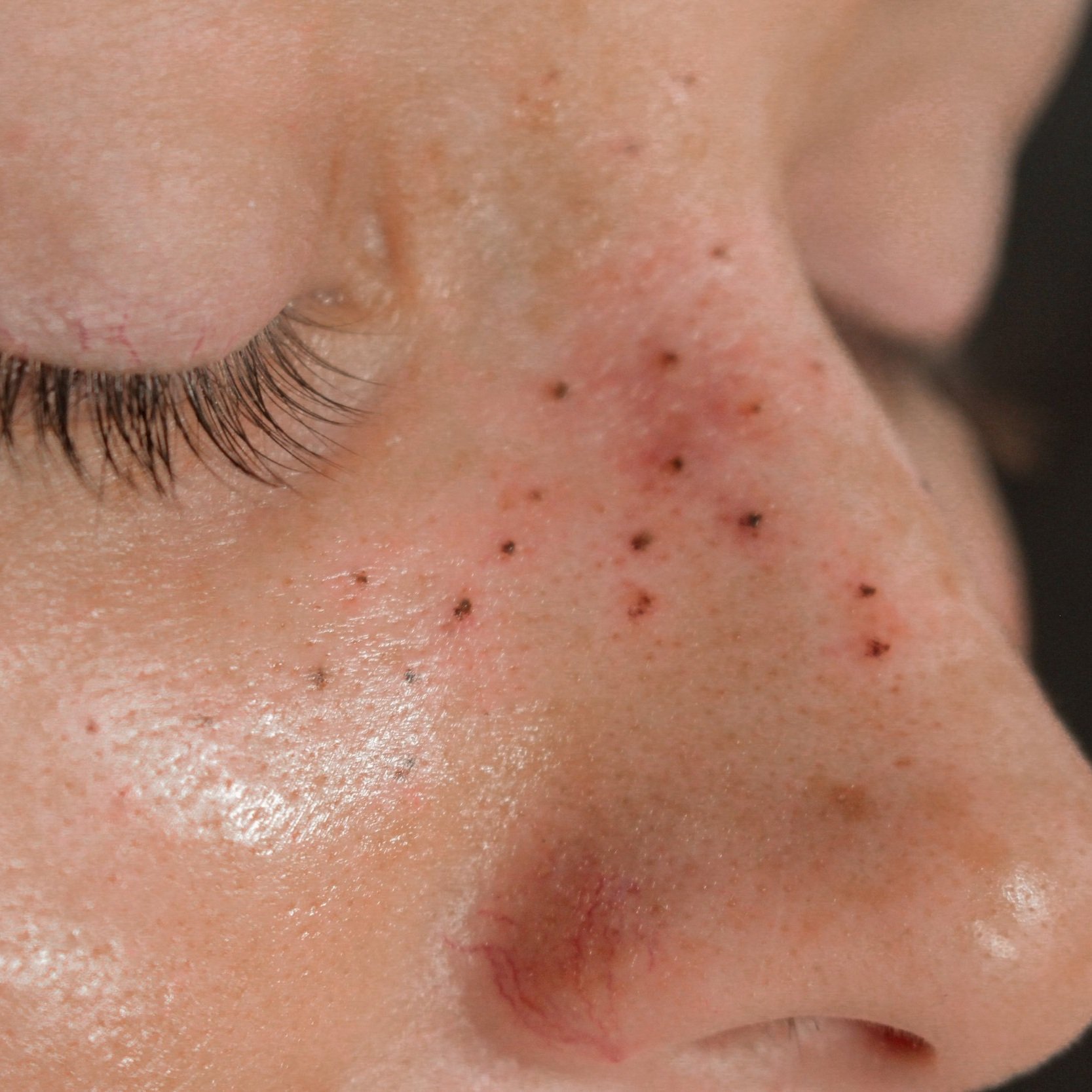 Level 1 sun kissed freckle tattoo