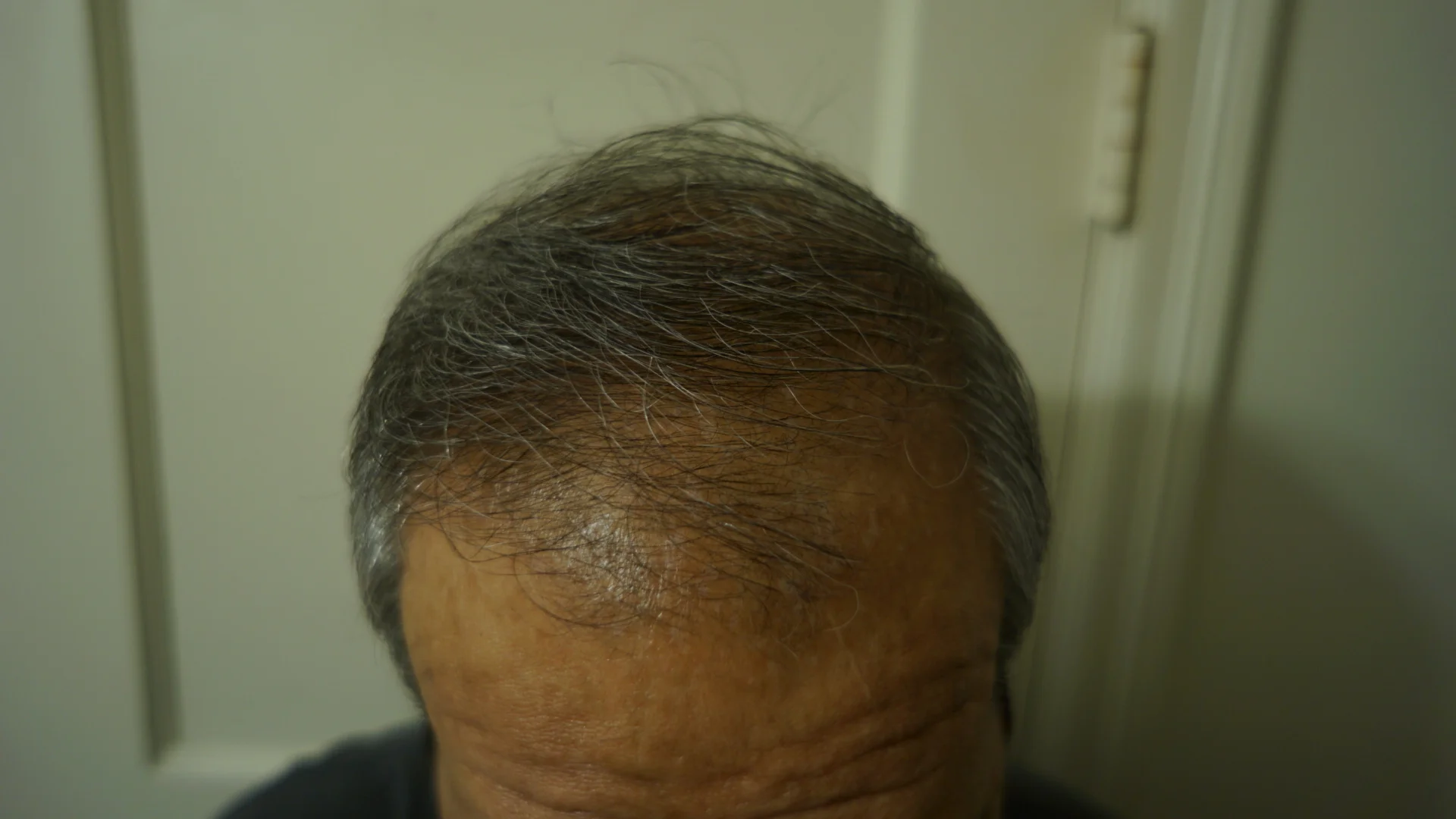 How to Postpone Balding